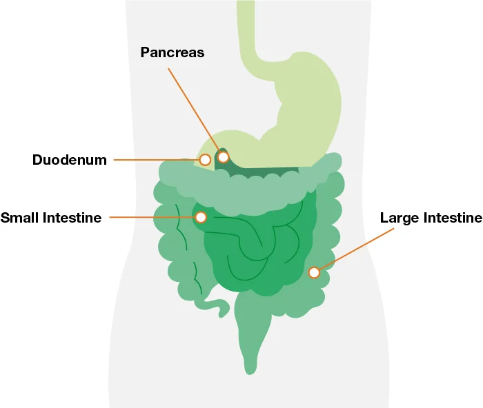 Illustration shows pancreas, large intestine, small intestine, and duodenum.